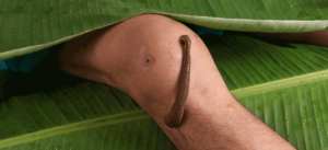 Leech Therapy for Cancer