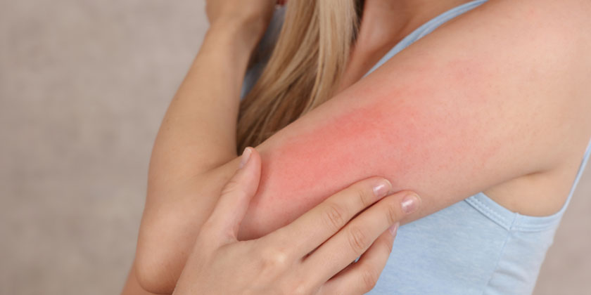 Allergy Symptoms