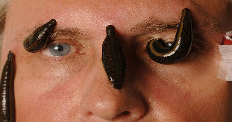 Cosmetic-and-Dermatological-Uses-leech-therapy
