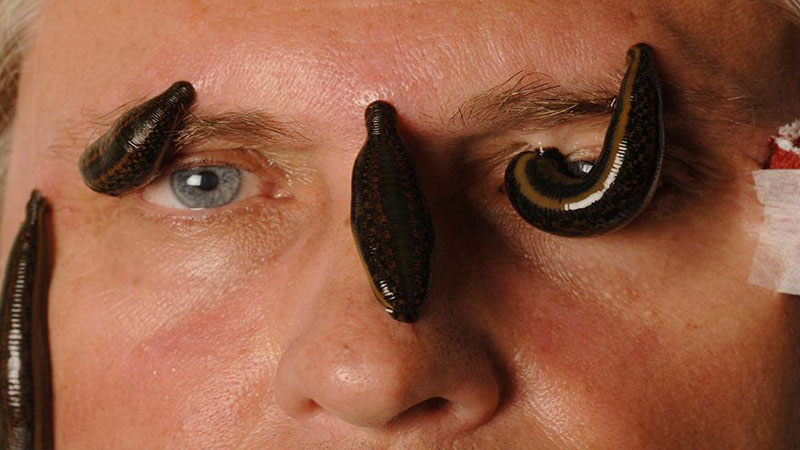 Cosmetic-and-Dermatological-Uses-leech-therapy