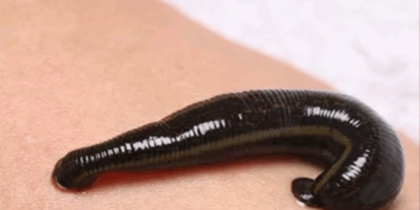Leech Therapy for Better Digestion