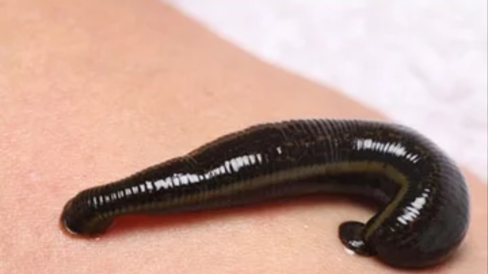Leech Therapy for Better Digestion