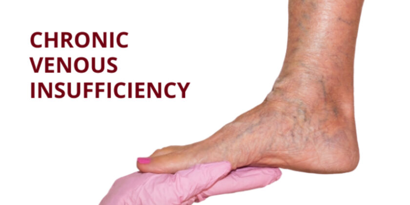 Chronic Venous