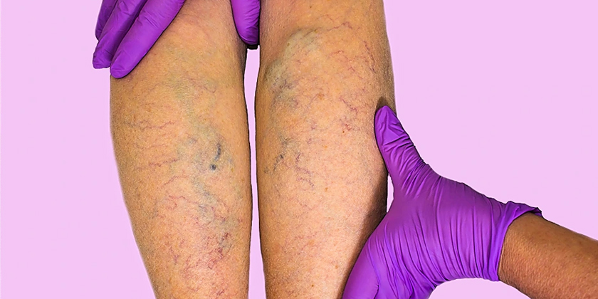 Chronic venous insufficiency made simple: a practical guide for patients