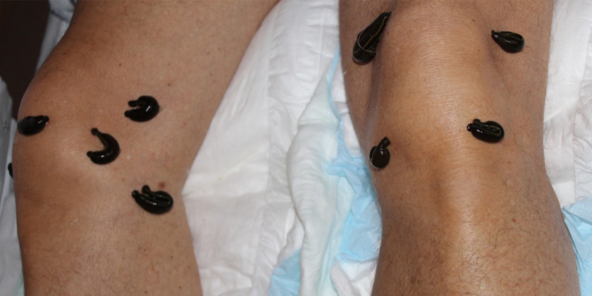 Discover the healing power of leech therapy: a promising solution for chronic venous health