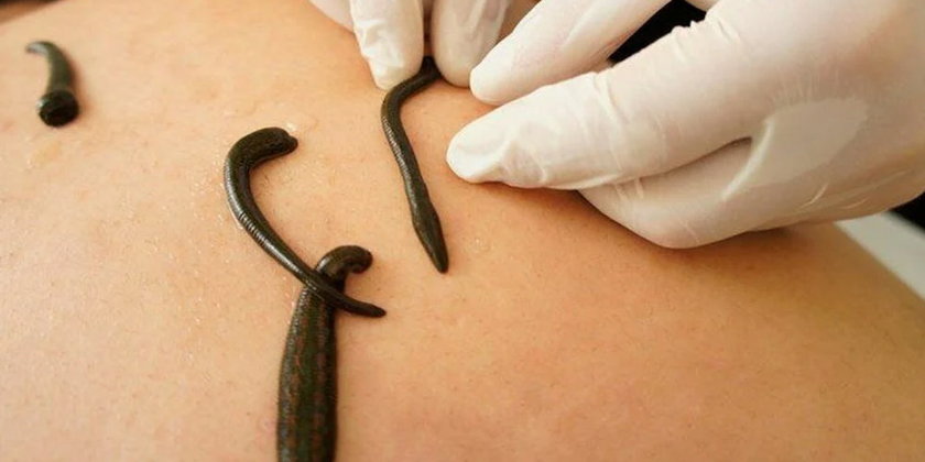 Leech Therapy: An Emerging Adjunct in Urological Post-Surgical Care
