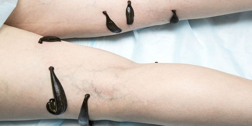 Leech Therapy for Deep Vein Thrombosis: What You Need to Know