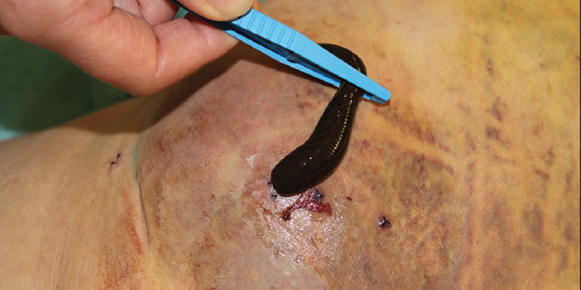 Leeches-in-Modern-Wound-Care-A-Breakthrough-in-Infection-Management