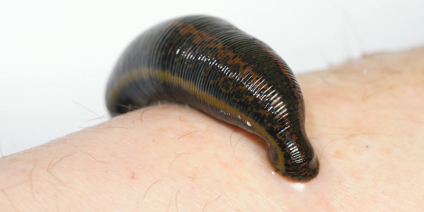 Reconstructive Microsurgery with Leech Therapy: What You Need to Know