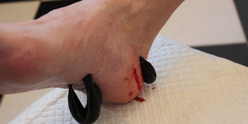 Sports Injuries and Musculoskeletal Disorders with Leech Therapy: What You Need to Know