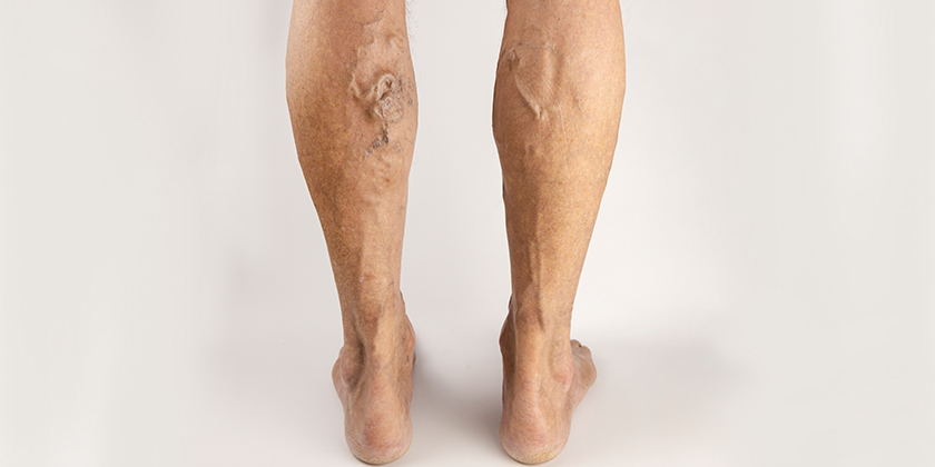 The Ultimate Guide to Understanding Common Vascular Conditions