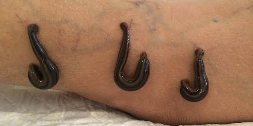 Using Leech Therapy to Improve Post-Injury Hematoma Healing