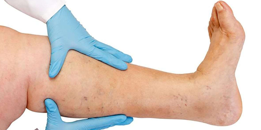 5 Signs of Chronic Venous Insufficiency You Can’t Ignore (And How to Treat It)