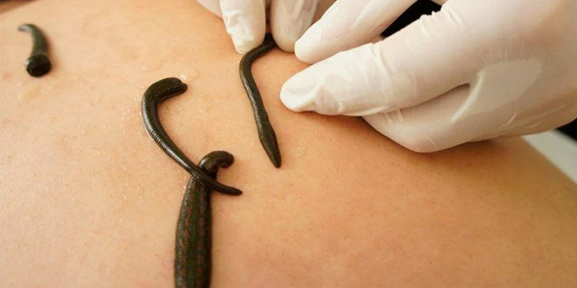 Ayurvedic GI Relief: Leech Therapy for Better Digestion
