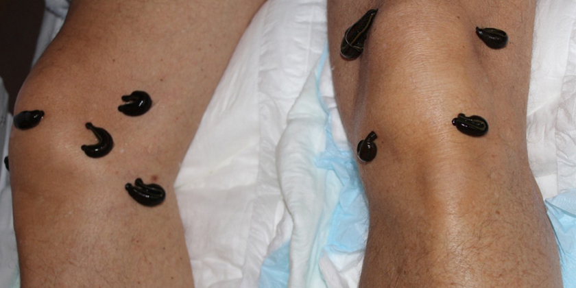 How Leech Therapy Can Transform Your Vein Health: A Must-Read Guide