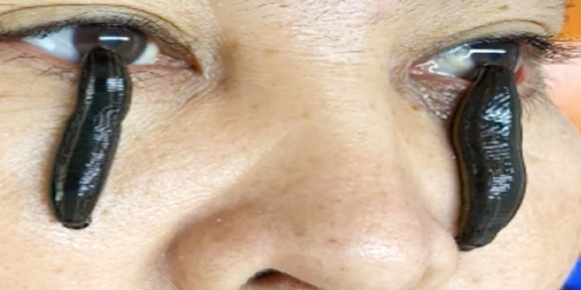 Leech Therapy for Eye Disorders: A Natural Vision Care Breakthrough