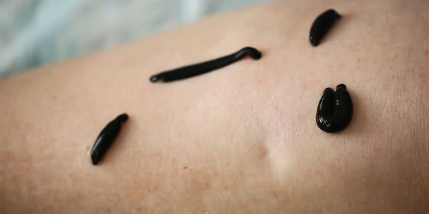 Leech Therapy for Heart Disease: A Natural Breakthrough You Need to Know