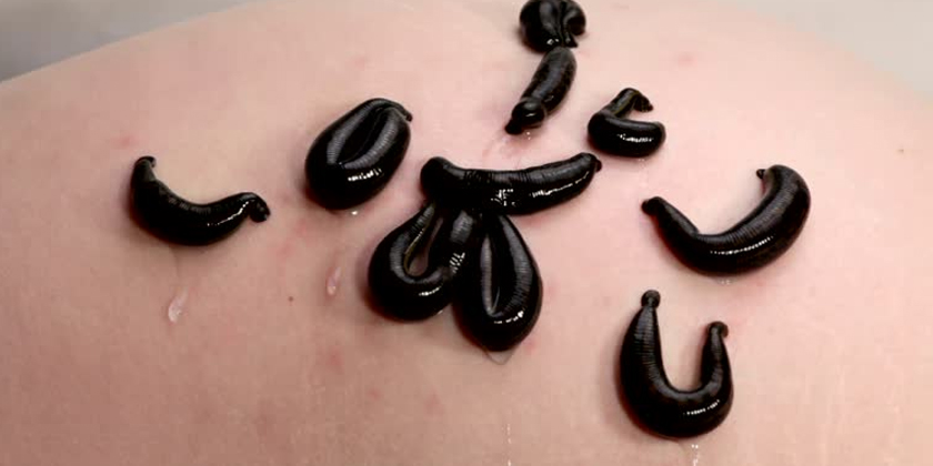 Leech Therapy for Improved Healing After Gynecological Procedures