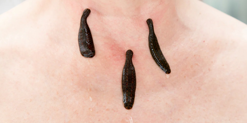 Leech Treatment for Ear, Nose, and Throat Disorders: